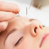 Acupuntura